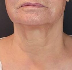 Sofwave Before & After Patient #1606